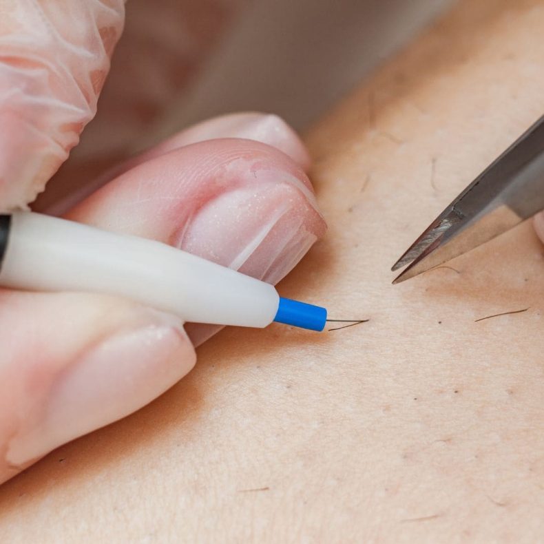 l’alternative au laser