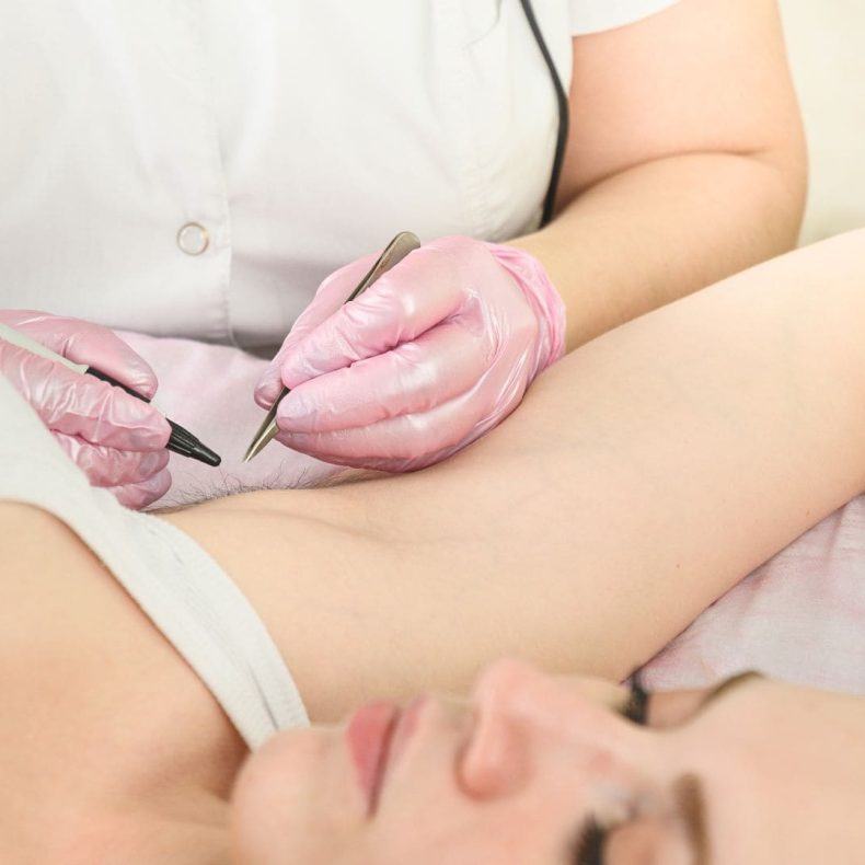 Épilation électrique par thermolyse