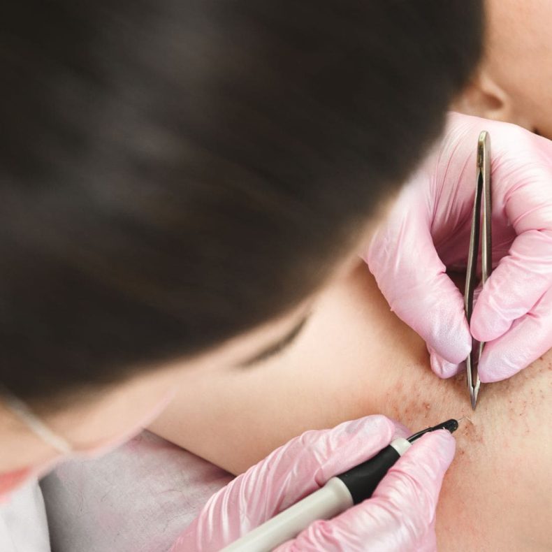 Épilation thermolyse